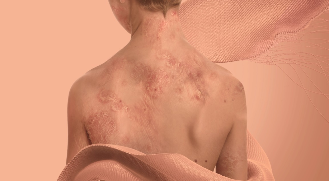 Cooper SKin, una oportunidad para pacientes con 'piel de mariposa' 